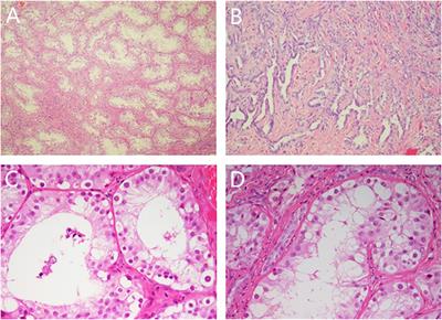 Case Report: Long-term follow-up of desert hedgehog variant caused 46, XY gonadal dysgenesis with multiple complications in a Chinese child